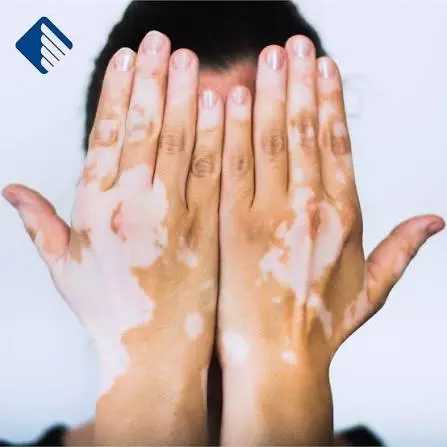 Vitiligo